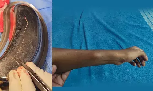 16കാരന്റെ കൈത്തണ്ടയില് 13 സെ.മീ നീളമുള്ള വിര; അപൂര്വ ശസ്ത്രക്രിയ 16കാരന്റെ കൈത്തണ്ടയില് 13 സെ.മീ നീളമുള്ള വിര; അപൂര്വ ശസ്ത്രക്രിയ