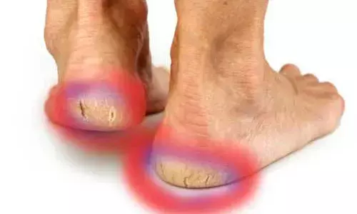 കാല്‍ പാദങ്ങളിലെ വിണ്ടുകീറല്‍ പ്രശ്നമാക്കേണ്ട; പരിഹാരമുണ്ട്