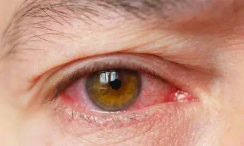 എന്താണ് ചെങ്കണ്ണ്; രോഗലക്ഷണങ്ങളും പരിഹാരങ്ങളും അറിയാം