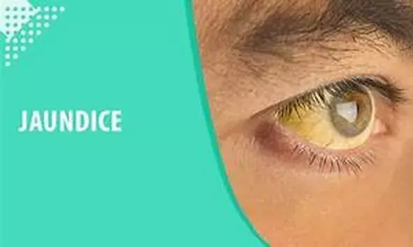 കാഞ്ഞങ്ങാടിന്റെ സമീപ പ്രദേശങ്ങളില് മഞ്ഞപ്പിത്തം പടരുന്നു; അധികൃതര് ജാഗ്രതാ നിര്ദേശം നല്കി കാഞ്ഞങ്ങാടിന്റെ സമീപ പ്രദേശങ്ങളില് മഞ്ഞപ്പിത്തം പടരുന്നു; അധികൃതര് ജാഗ്രതാ നിര്ദേശം നല്കി