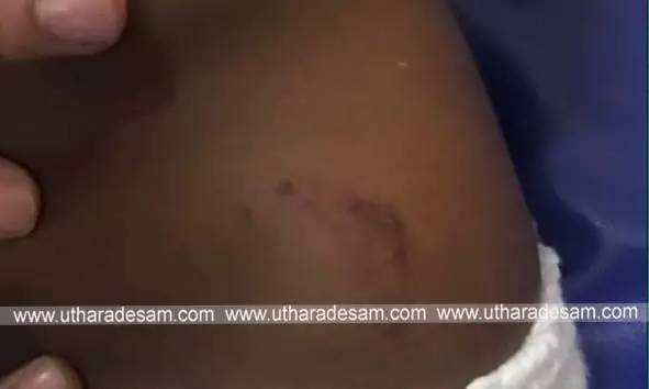 വീട്ടുമുറ്റത്ത് കളിച്ചുകൊണ്ടിരുന്ന 4 വയസുകാരിയെ തെരുവ് നായ്ക്കള്‍ കടിച്ച് പരിക്കേല്‍പ്പിച്ചു
