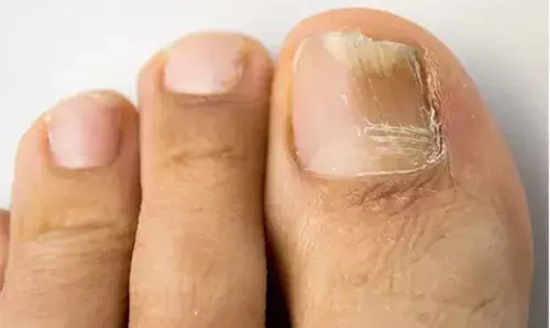 കുഴിനഖത്തിന് പരിഹാരം വീട്ടില്‍ തന്നെ; അറിയാം ചില നുറുങ്ങുകള്‍