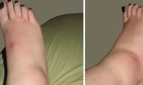 കണങ്കാലുകളിലേയും കാലുകളിലേയും വീക്കം കുറയ്ക്കാനുള്ള പ്രകൃതിദത്ത വഴികള്‍ അറിയാം