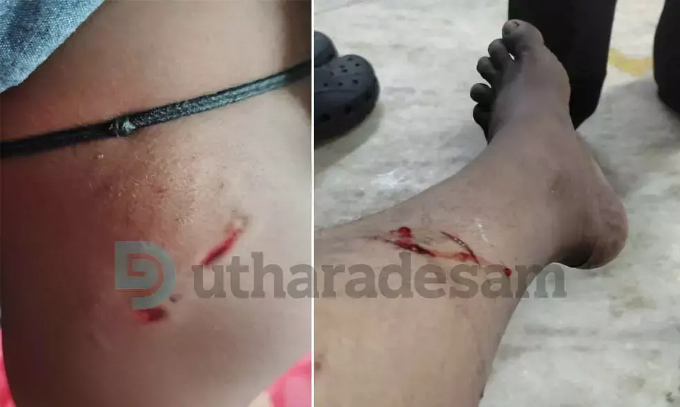 ജില്ലയില്‍ തെരുവുനായ ശല്യം രൂക്ഷമാകുന്നു; ബദിയടുക്കയില്‍ മൂന്ന് വയസ്സുകാരി ഉള്‍പ്പെടെ ആറ് പേര്‍ക്ക് കടിയേറ്റു.