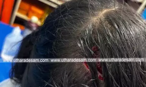 അയല്‍വീട്ടിലെ വളര്‍ത്തുനായയുടെ കടിയേറ്റ് വിദ്യാര്‍ത്ഥിനിക്ക് പരിക്ക്