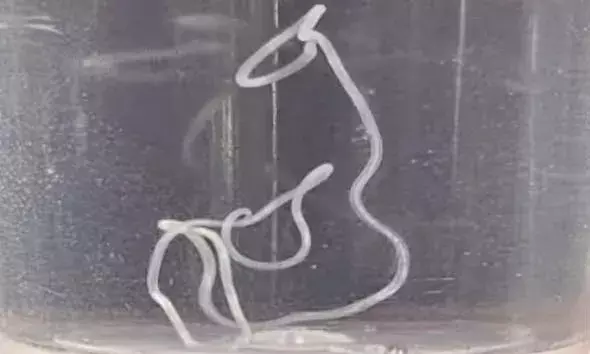 കണ്ണില്‍ അസഹ്യമായ ചൊറിച്ചിലും വേദനയും; പരിശോധിച്ചപ്പോള്‍ കണ്ടത് ജീവനോടെയുള്ള വിരയെ; ശസ്ത്രക്രിയയിലൂടെ പുറത്തെടുത്തു